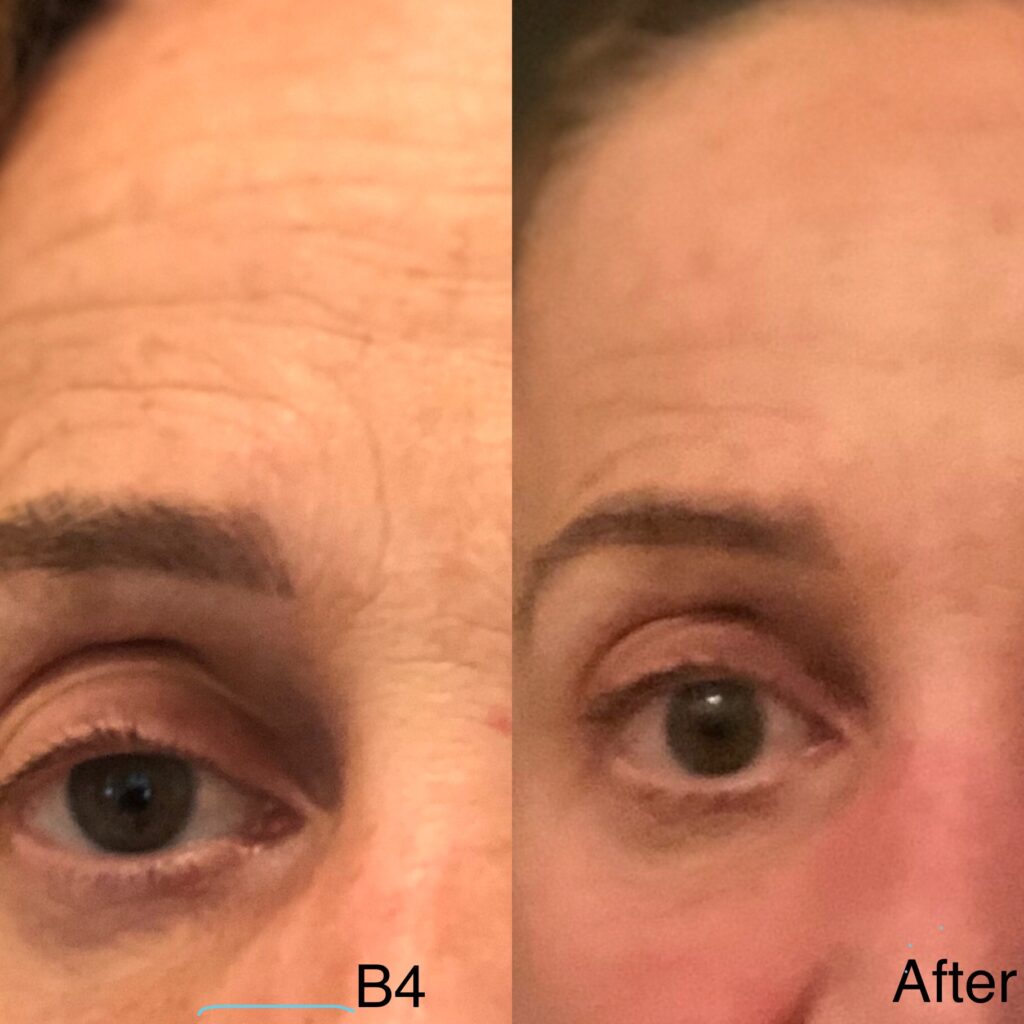 486A3CA4-4FB0-4882-B121-6D7FBD931C71 Beverly Hills Sculptural Face Lifting Result