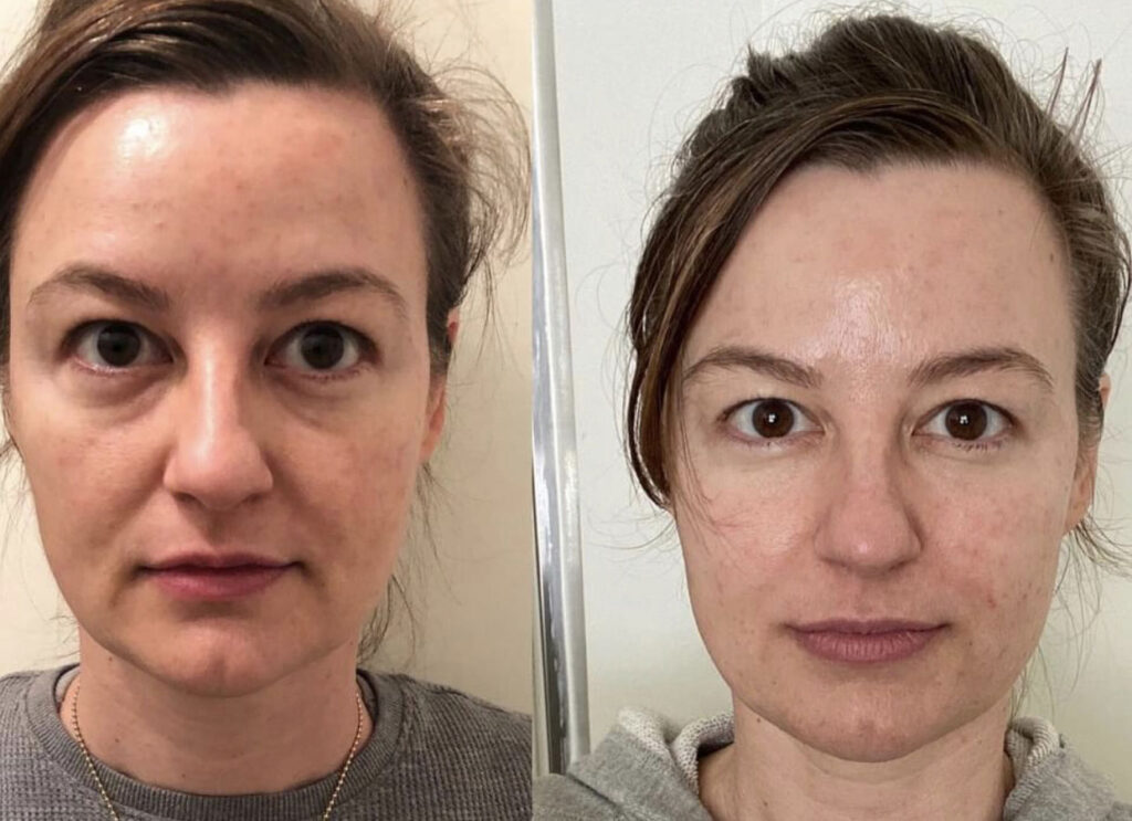 IMG_5185 Before and After Facial Sculpting Los Angeles