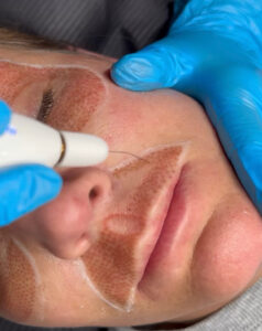 Fibroplasma Skin Tightening Non Invasive Procedure in Los Angeles